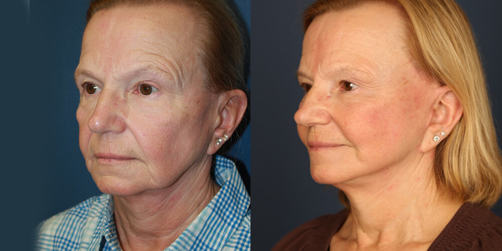 Before and After Image