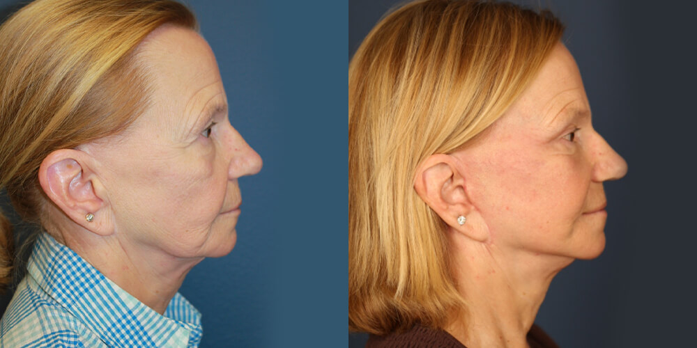 Before and After Image