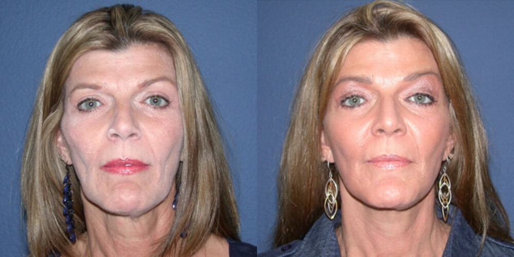 Before and After Image