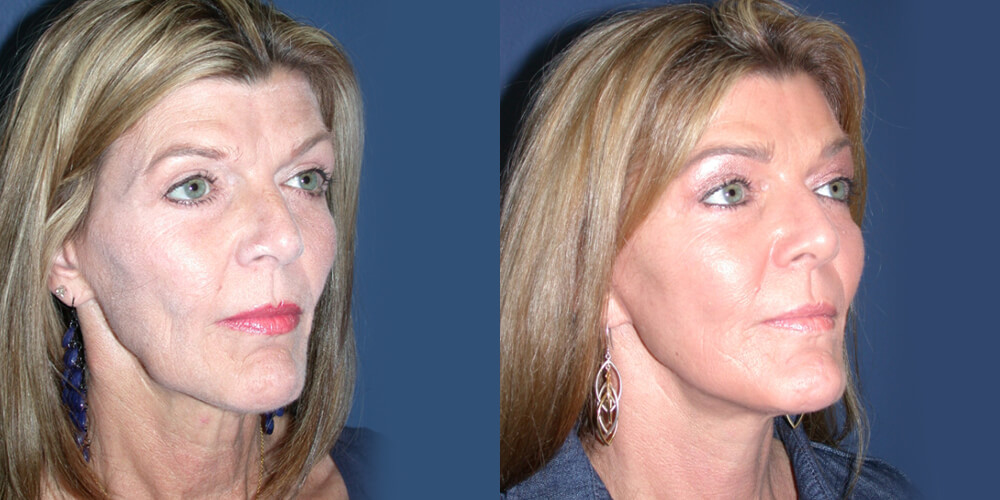 Before and After Image