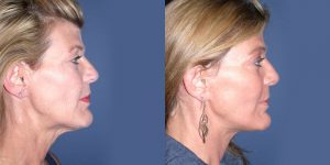 Before and After Image