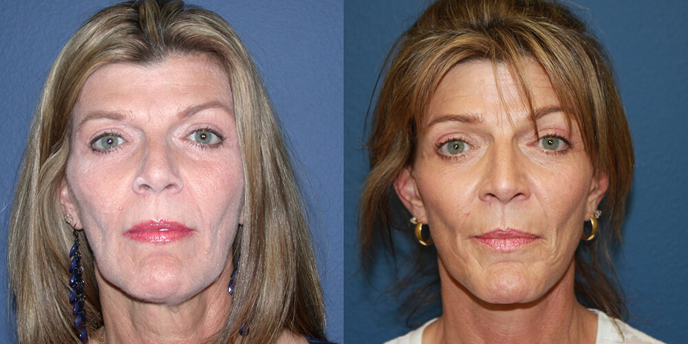 Before and After Image