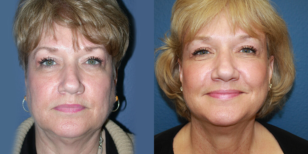 face-neck-p8-a Facelift and Neck Lift before and after image.