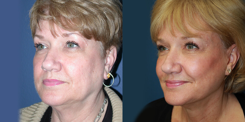 Before and After Image