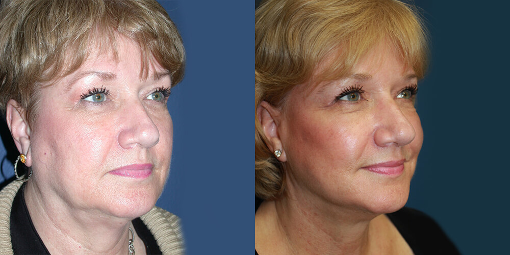 Before and After Image