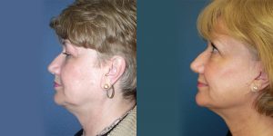 Before and After Image