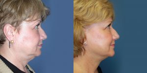 Before and After Image