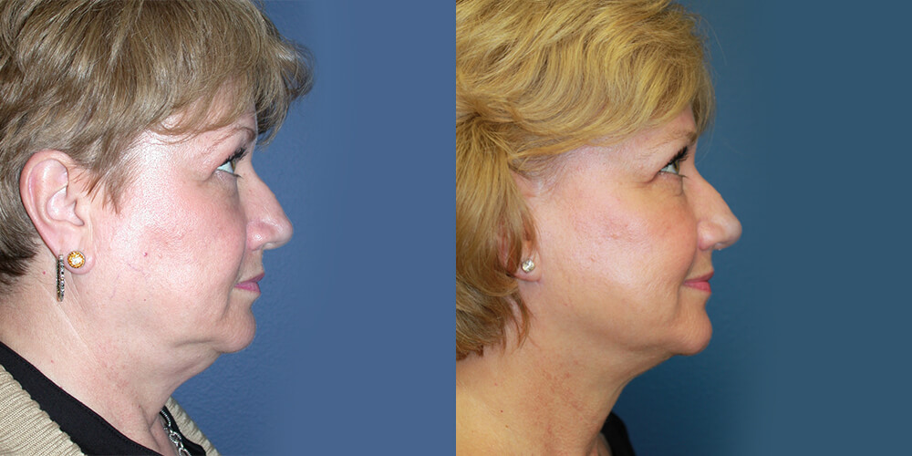 Before and After Image