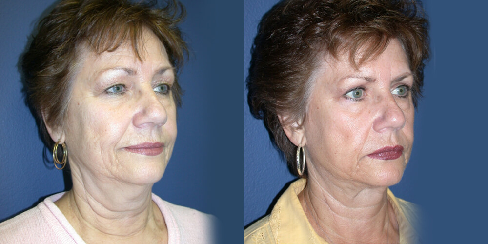 Before and After Image