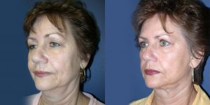 Before and After Image