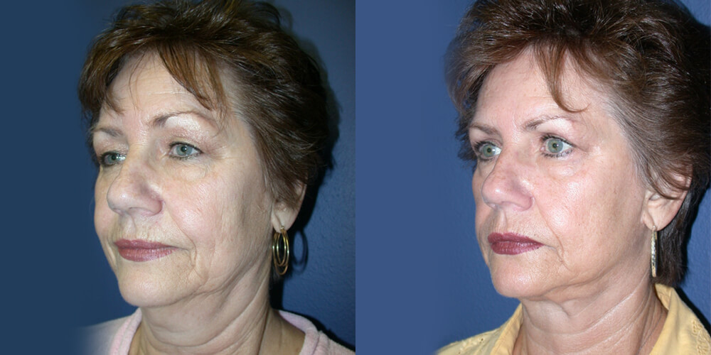 Before and After Image