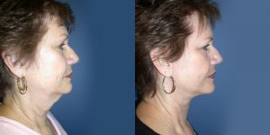 Before and After Image