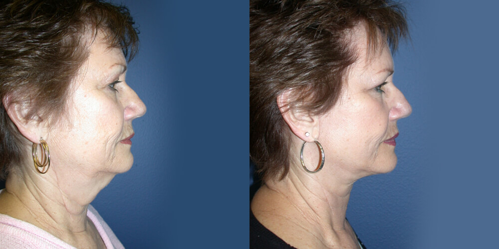 Before and After Image