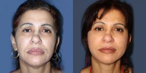 Before and After Image