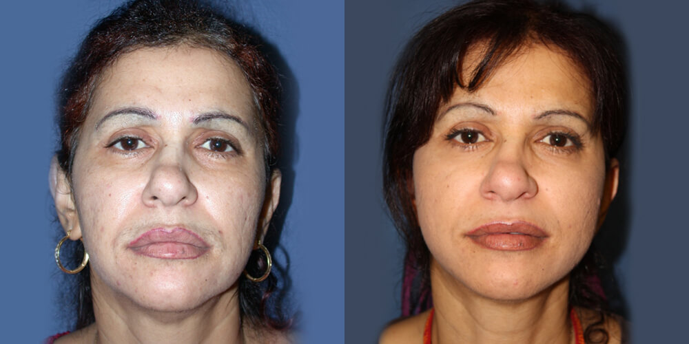 Before and After Image