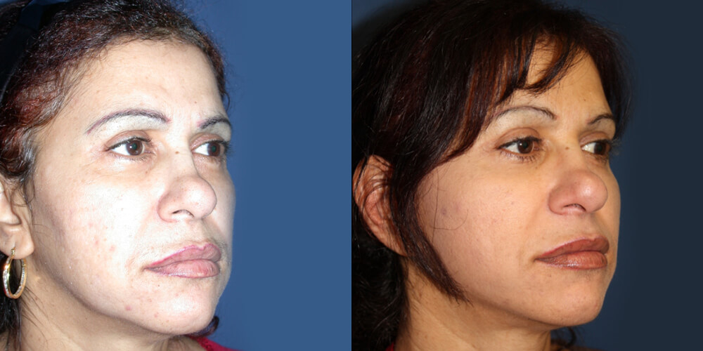 Before and After Image