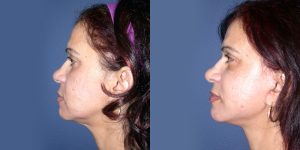 Before and After Image