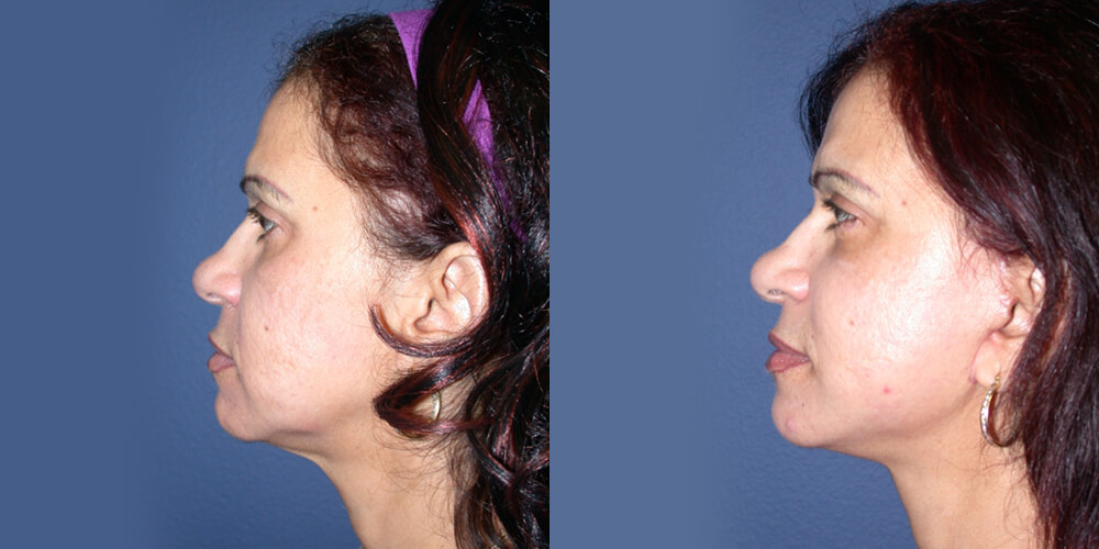 Before and After Image