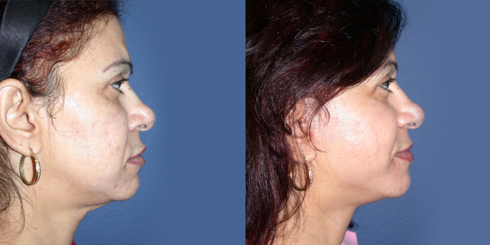 Before and After Image