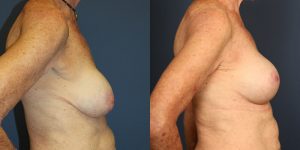 Before and After Image