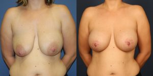 Before and After Image