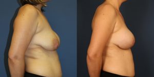 Before and After Image