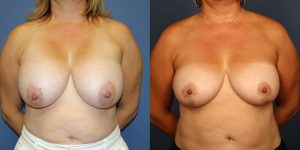 Before and After Image