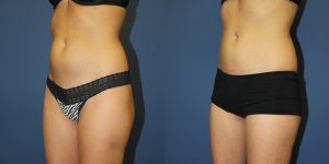 Before and After Image
