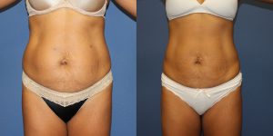 Before and After Image