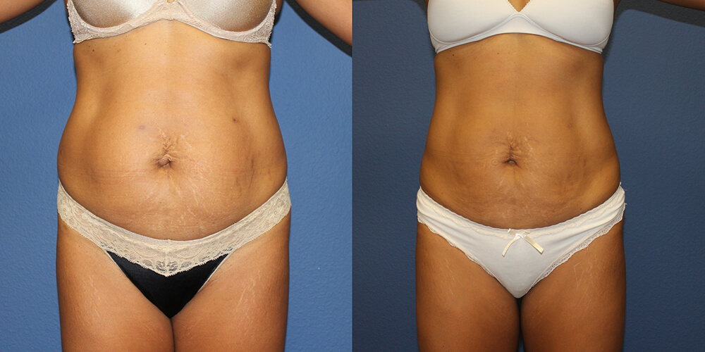 Before and After Image