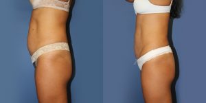 Before and After Image