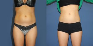 Before and After Image