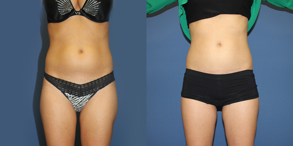 Before and After Image