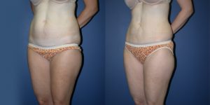 Before and After Image