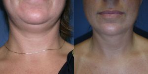 Before and After Image
