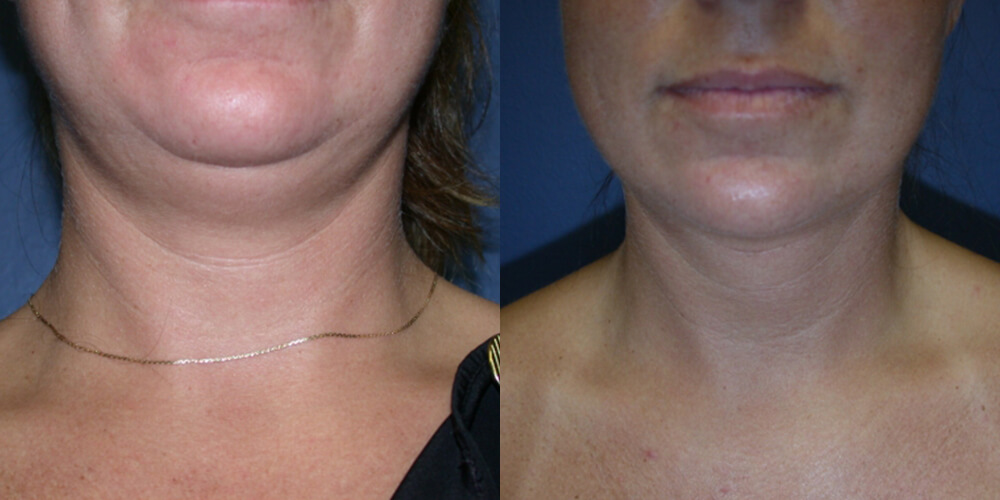 Before and After Image