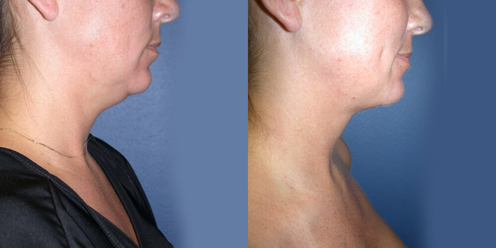 Before and After Image