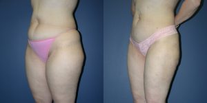 Before and After Image