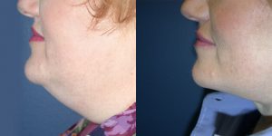 Before and After Image