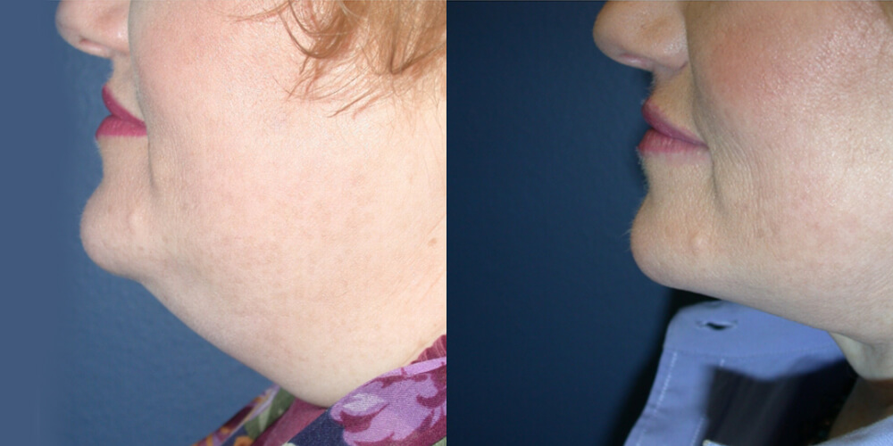 Before and After Image