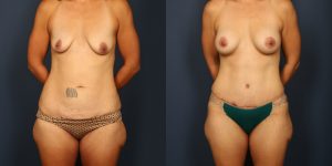 Before and After Image