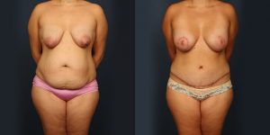 Before and After Image