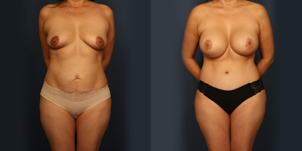 mm-p5-a Mommy Makeover before and after.