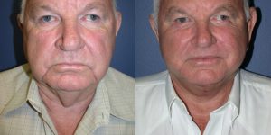 Before and After Image