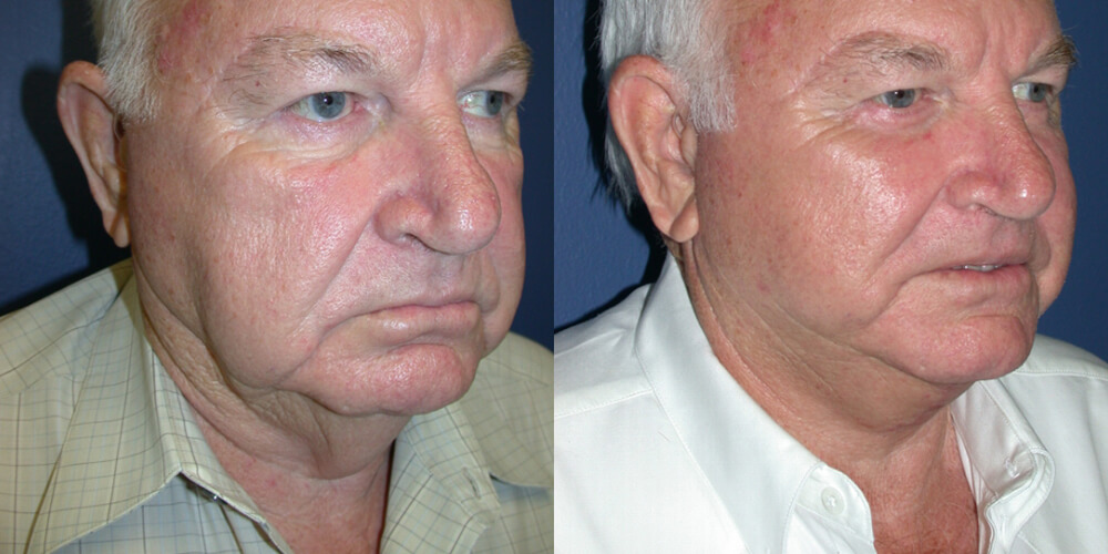 Before and After Image