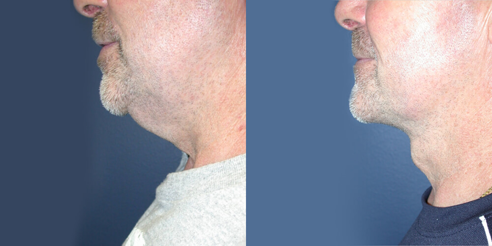 Before and After Image