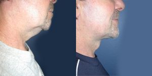 Before and After Image