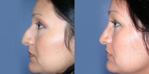 Before and After Image