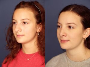 Before and After Image