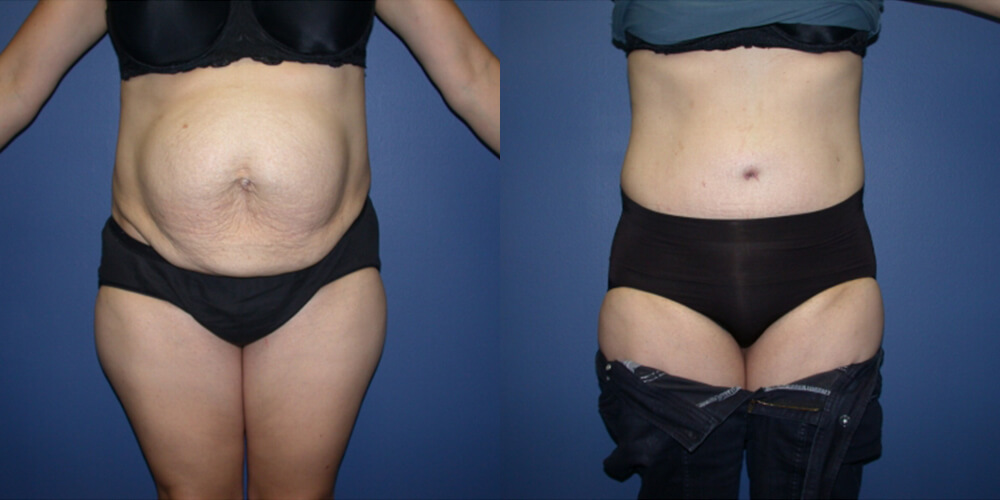 Before and After Image